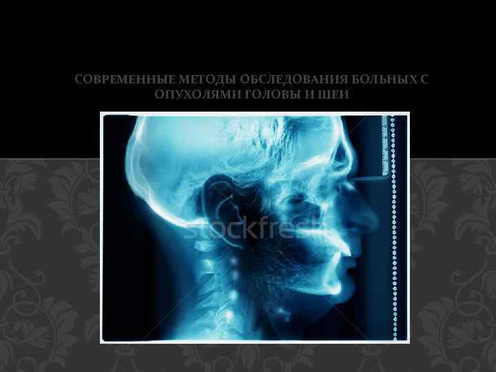 СОВРЕМЕННЫЕ МЕТОДЫ ОБСЛЕДОВАНИЯ БОЛЬНЫХ С ОПУХОЛЯМИ ГОЛОВЫ И ШЕИ 