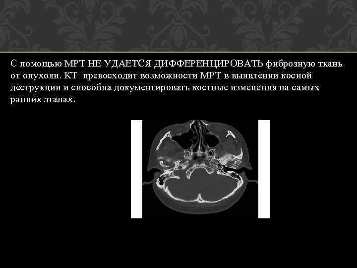 С помощью МРТ НЕ УДАЕТСЯ ДИФФЕРЕНЦИРОВАТЬ фиброзную ткань от опухоли. КТ превосходит возможности МРТ