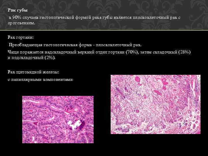 Рак губы в 90% случаев гистологической формой рака губы является плоскоклеточный рак с ороговением.