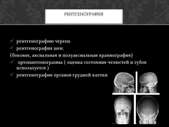 РЕНТГЕНОГРАФИЯ ü рентгенографию черепа ü рентгенография шеи. (боковая, аксиальная и полуаксиальная краниография) ü ортопантомограмма