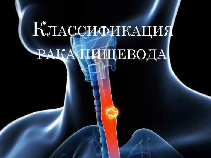 КЛАССИФИКАЦИЯ РАКА ПИЩЕВОДА 