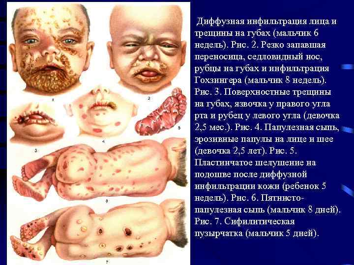  Диффузная инфильтрация лица и трещины на губах (мальчик 6 недель). Рис. 2. Резко