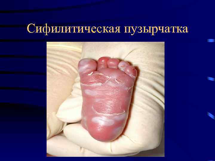 Сифилитическая пузырчатка 