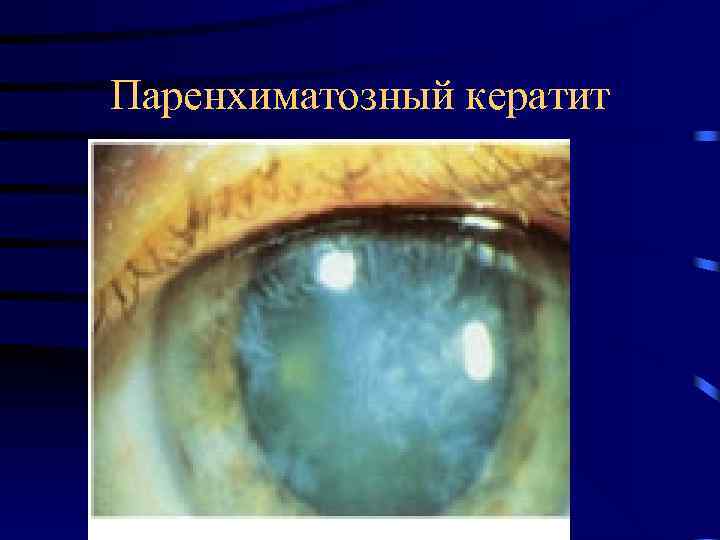 Паренхиматозный кератит 
