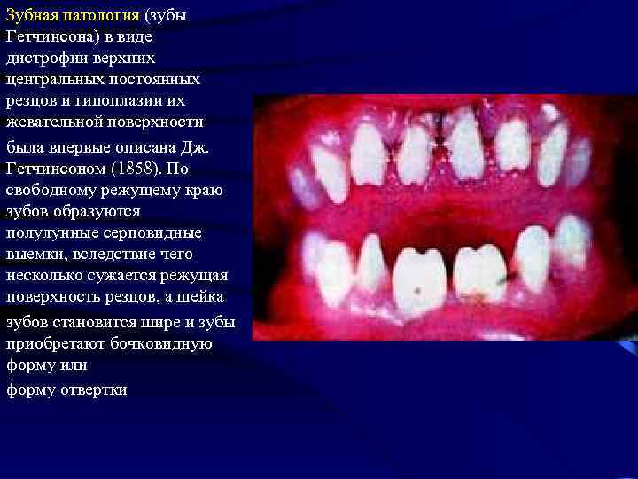 Зубная патология (зубы Гетчинсона) в виде дистрофии верхних центральных постоянных резцов и гипоплазии их