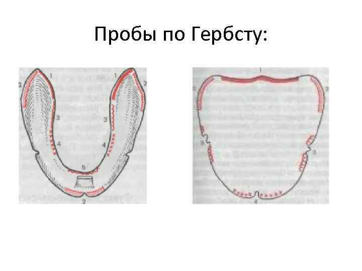 Гербера гербста. Пробы по Гербсту для верхней челюсти. Функциональные пробы Гербста на верхней челюсти. Функциональные пробы Гербста на нижней челюсти. Функциональные пробы в ортопедической стоматологии.