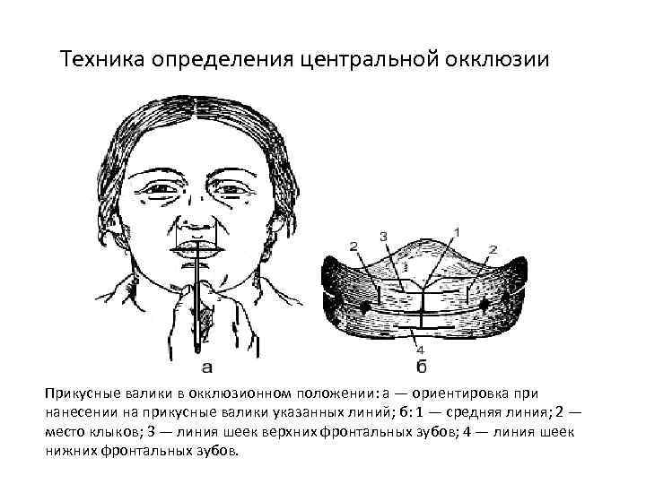 Определение центрального соотношения челюстей при полном отсутствии зубов презентация