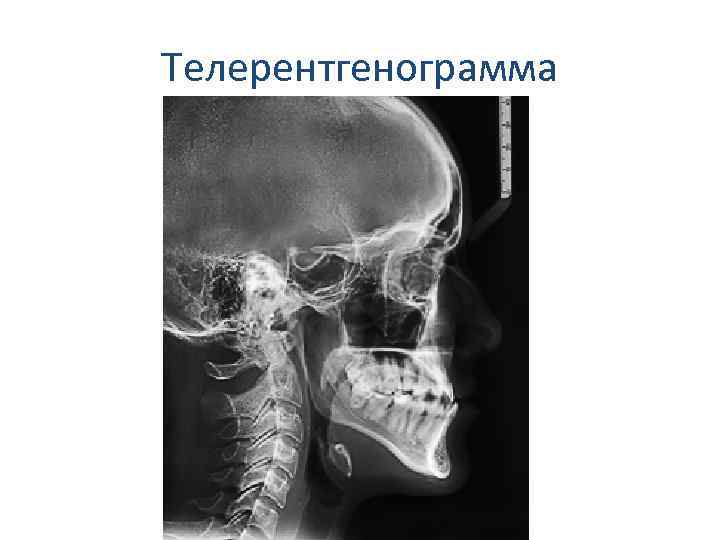 Трг снимок. Рентген ТРГ В боковой проекции. ТРГ черепа в боковой проекции.