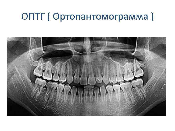 ОПТГ ( Ортопантомограмма ) 