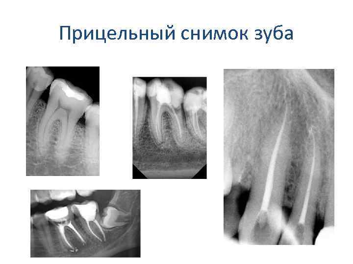 Прицельный снимок зуба. Прицельный рентген снимок. Снимок 28 зуба прицельный внутриротовой. Внутриротовая прицельная рентгенограмма зуба. Прицельные рентгеновские снимки зубов.