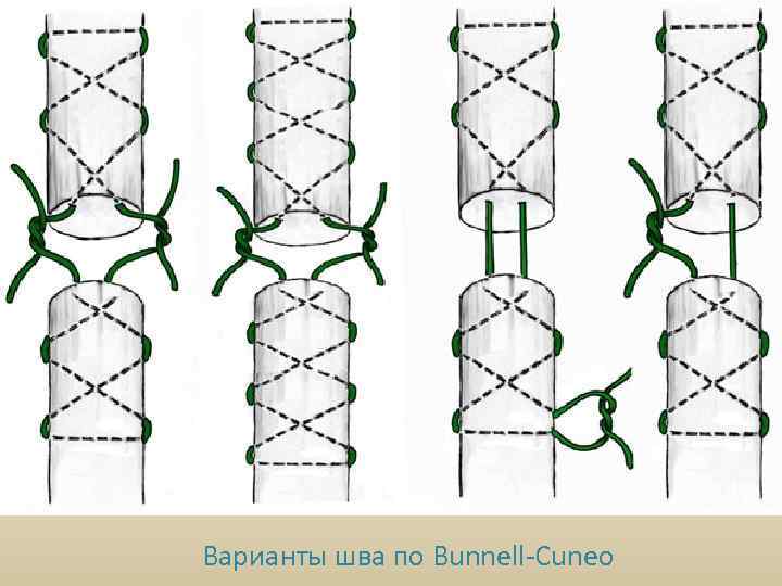 Варианты шва по Bunnell-Cuneo 