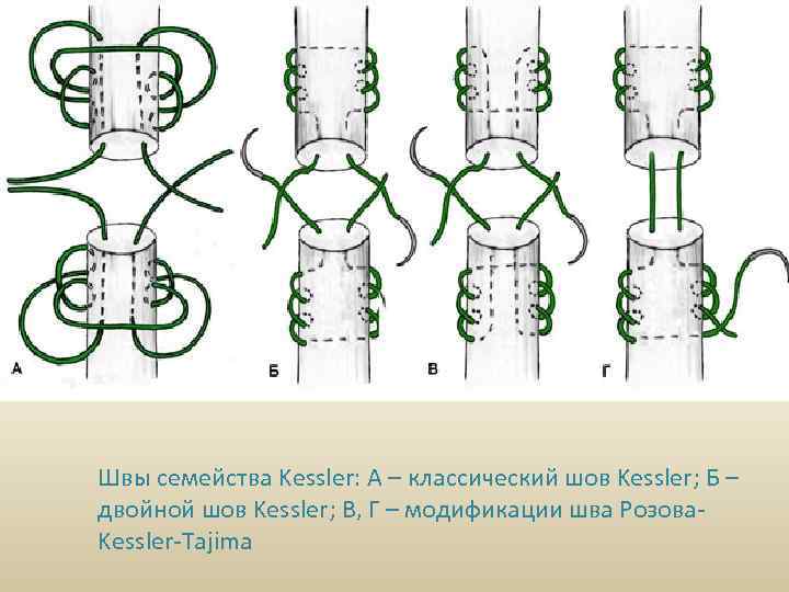 Швы семейства Kessler: А – классический шов Kessler; Б – двойной шов Kessler; В,