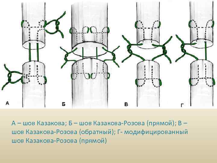А – шов Казакова; Б – шов Казакова-Розова (прямой); В – шов Казакова-Розова (обратный);