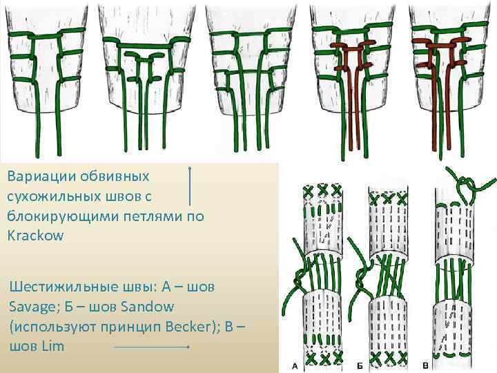 Вариации обвивных сухожильных швов с блокирующими петлями по Krackow Шестижильные швы: А – шов