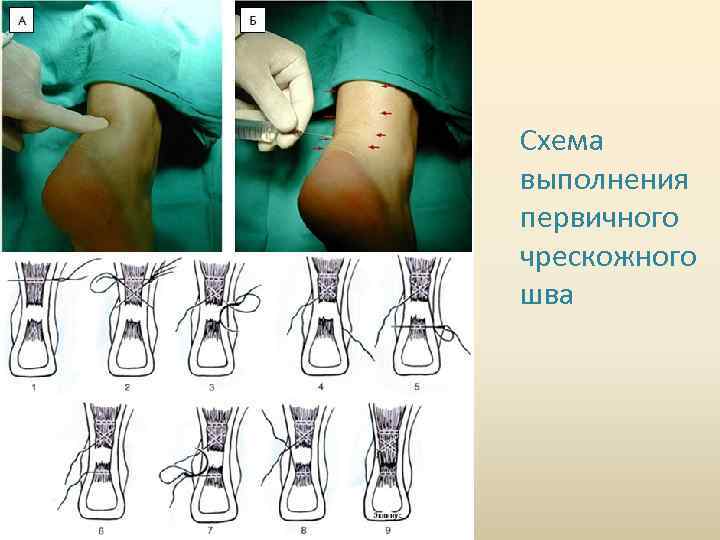 Схема выполнения первичного чрескожного шва 