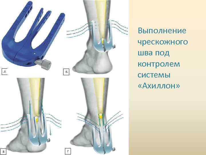 Выполнение чрескожного шва под контролем системы «Ахиллон» 