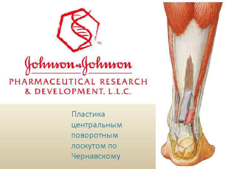 Лечение хронических разрывов. Пластика центральным поворотным лоскутом по Чернавскому 