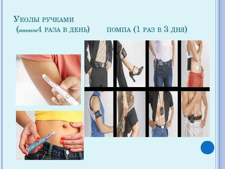 УКОЛЫ РУЧКАМИ ( 4 РАЗА В ДЕНЬ) МИНИМУМ ПОМПА (1 РАЗ В 3 ДНЯ)