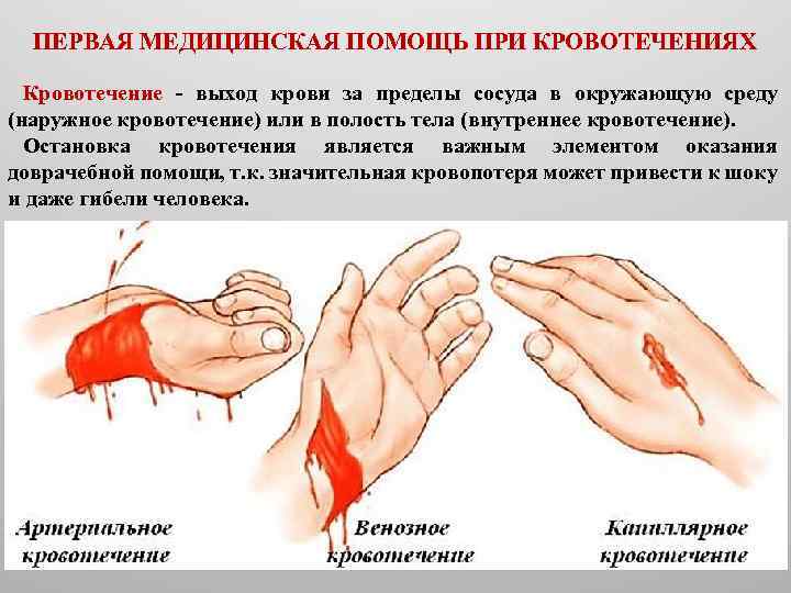 ПЕРВАЯ МЕДИЦИНСКАЯ ПОМОЩЬ ПРИ КРОВОТЕЧЕНИЯХ Кровотечение выход крови за пределы сосуда в окружающую среду