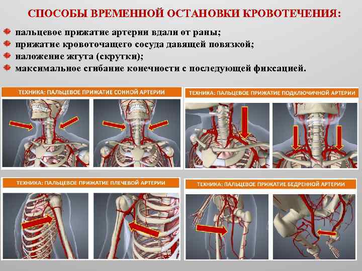 СПОСОБЫ ВРЕМЕННОЙ ОСТАНОВКИ КРОВОТЕЧЕНИЯ: пальцевое прижатие артерии вдали от раны; прижатие кровоточащего сосуда давящей