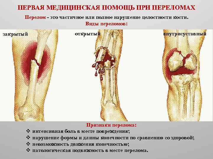 ПЕРВАЯ МЕДИЦИНСКАЯ ПОМОЩЬ ПРИ ПЕРЕЛОМАХ Перелом это частичное или полное нарушение целостности кости. Виды