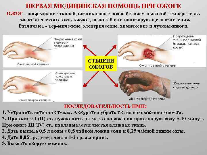 ПЕРВАЯ МЕДИЦИНСКАЯ ПОМОЩЬ ПРИ ОЖОГЕ ОЖОГ повреждение тканей, возникающее под действием высокой температуры, электри