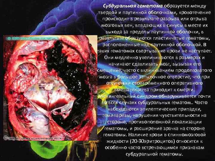 Субдуральная гематома образуется между твердой и паутинной оболочками, кровотечение происходит в результате разрыва или