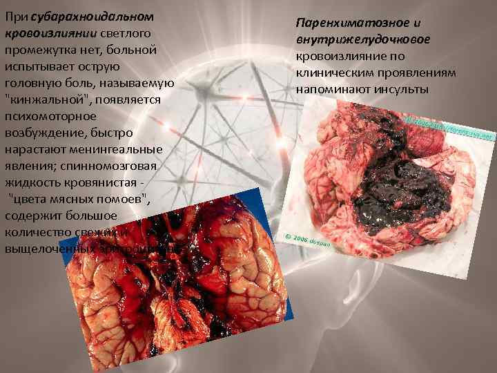 При субарахноидальном кровоизлиянии светлого промежутка нет, больной испытывает острую головную боль, называемую 