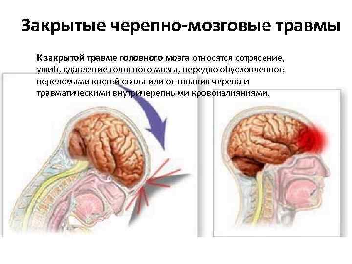 Закрытые черепно-мозговые травмы К закрытой травме головного мозга относятся сотрясение, ушиб, сдавление головного мозга,