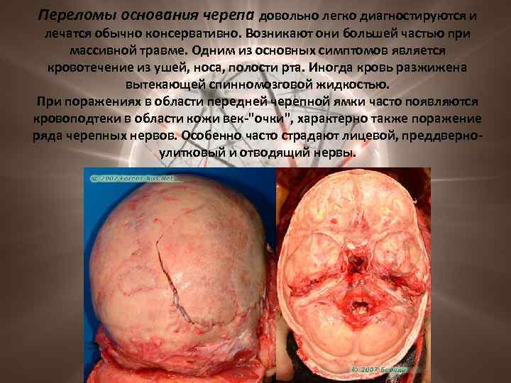 Переломы основания черепа довольно легко диагностируются и лечатся обычно консервативно. Возникают они большей частью