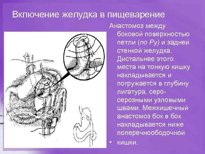 Включение желудка в пищеварение Анастомоз между боковой поверхностью петли (по Ру) и задней стенкой