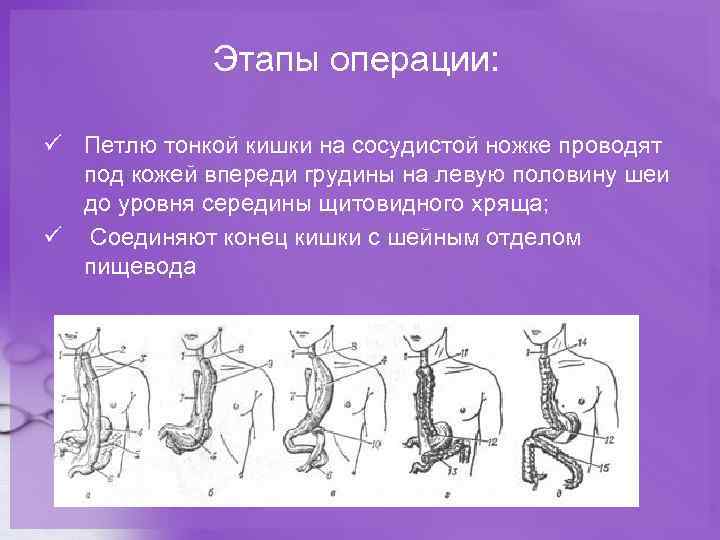 Этапы операции: ü Петлю тонкой кишки на сосудистой ножке проводят под кожей впереди грудины