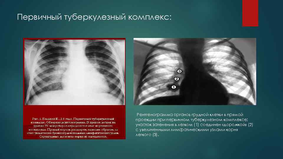 Первичный туберкулезный комплекс: Рентгенограмма органов грудной клетки в прямой проекции при первичном туберкулезном комплексе: