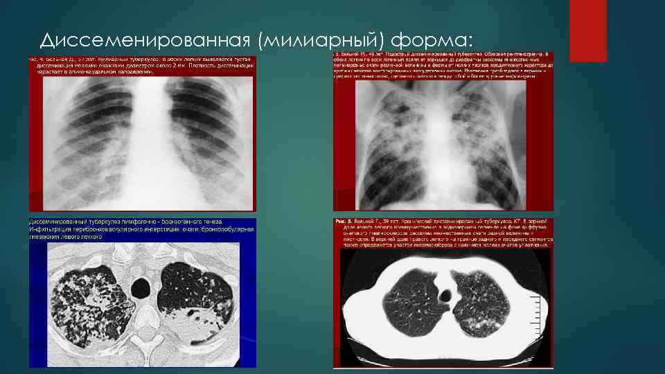 Презентация диагностика туберкулеза легких