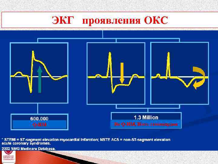 Лечение инфаркта без подъема. ЭКГ при остром коронарном синдроме. ЭКГ при Окс с подъемом сегмента St.