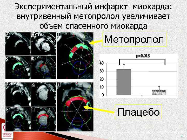 Экспериментальный инфаркт миокарда: внутривенный метопролол увеличивает объем спасенного миокарда Метопролол Плацебо Ibanez, B. et