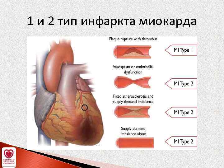 1 и 2 тип инфаркта миокарда 