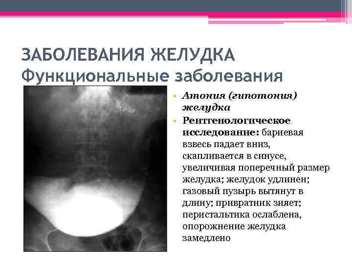 ЗАБОЛЕВАНИЯ ЖЕЛУДКА Функциональные заболевания • Атония (гипотония) желудка • Рентгенологическое исследование: бариевая взвесь падает
