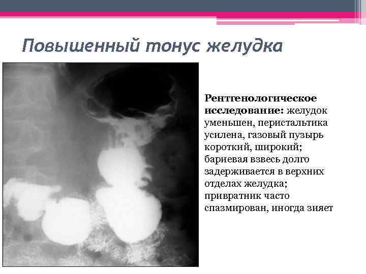 Повышенный тонус желудка • Рентгенологическое исследование: желудок уменьшен, перистальтика усилена, газовый пузырь короткий, широкий;