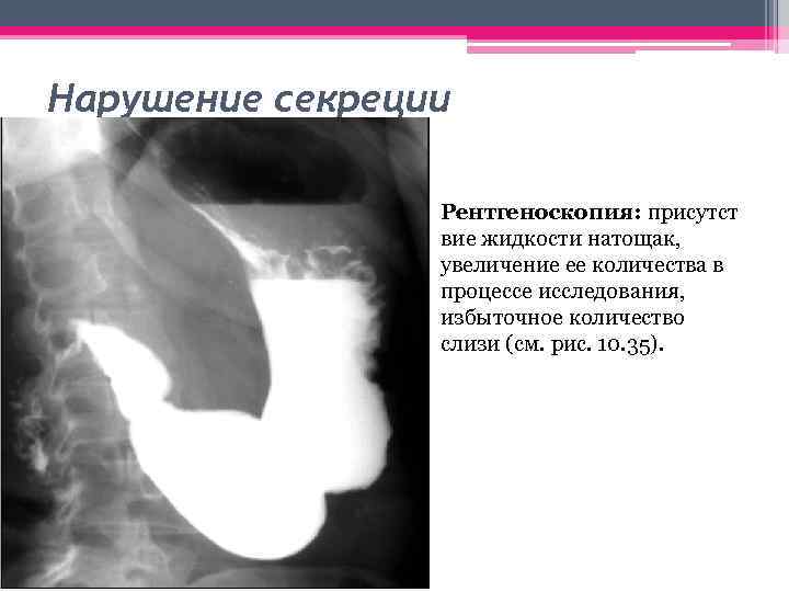 Нарушение секреции • Рентгеноскопия: присутст вие жидкости натощак, увеличение ее количества в процессе исследования,