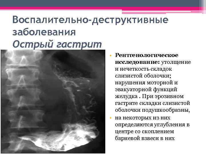 Воспалительно-деструктивные заболевания Острый гастрит • Рентгенологическое исследование: утолщение и нечеткость складок слизистой оболочки; нарушения