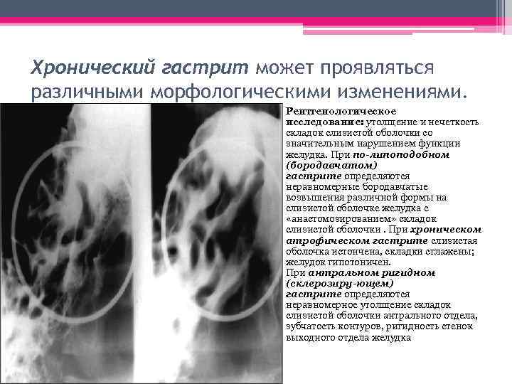 Хронический гастрит может проявляться различными морфологическими изменениями. • Рентгенологическое исследование: утолщение и нечеткость складок