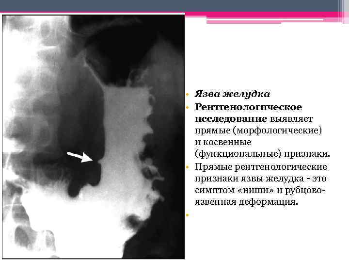  • Язва желудка • Рентгенологическое исследование выявляет прямые (морфологические) и косвенные (функциональные) признаки.