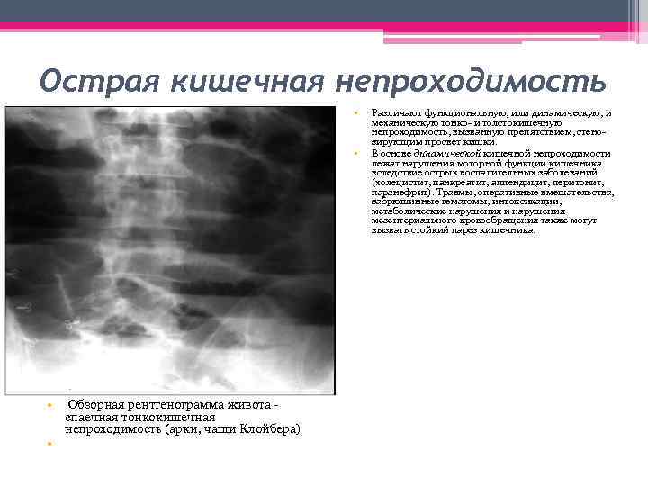 Острая кишечная непроходимость • • • Обзорная рентгенограмма живота - спаечная тонкокишечная непроходимость (арки,