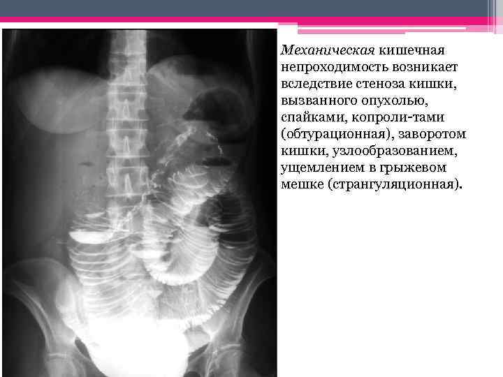  • Механическая кишечная непроходимость возникает вследствие стеноза кишки, вызванного опухолью, спайками, копроли-тами (обтурационная),