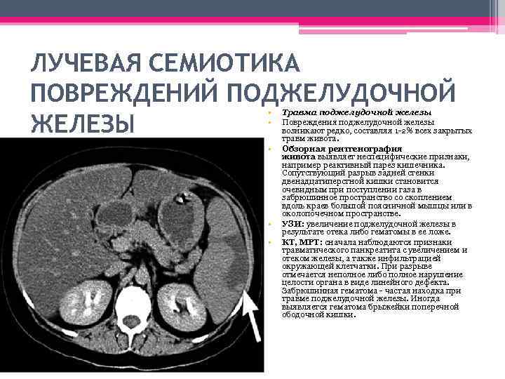 ЛУЧЕВАЯ СЕМИОТИКА ПОВРЕЖДЕНИЙ ПОДЖЕЛУДОЧНОЙ ЖЕЛЕЗЫ • • • Травма поджелудочной железы Повреждения поджелудочной железы