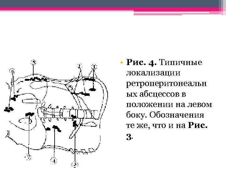 • Рис. 4. Типичные локализации ретроперитонеальн ых абсцессов в положении на левом боку.