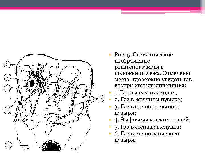  • Рис. 5. Схематическое изображение рентгенограммы в положении лежа. Отмечены места, где можно