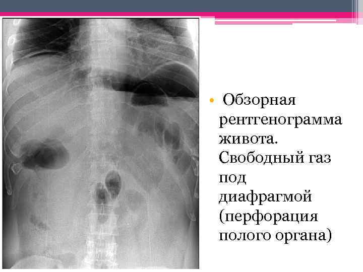  • Обзорная рентгенограмма живота. Свободный газ под диафрагмой (перфорация полого органа) 