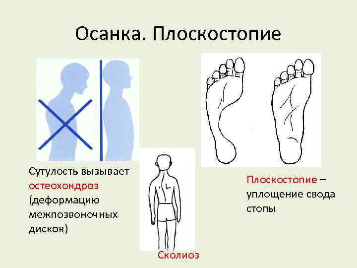 Осанка. Плоскостопие Сутулость вызывает остеохондроз (деформацию межпозвоночных дисков) Плоскостопие – уплощение свода стопы Сколиоз